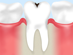 初期の虫歯は歯の再石灰化で解決！