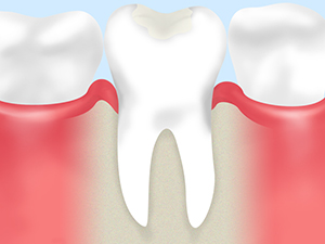 初期の虫歯は歯の再石灰化で解決！
