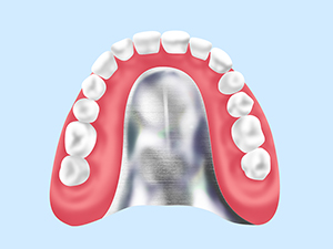 金属床義歯