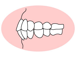 上下顎前突（じょうげがくぜんとつ）