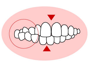 交叉咬合（こうさこうごう）